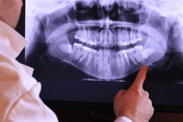 Best Emergency Wisdom Teeth Removal in St Croix Falls, WI